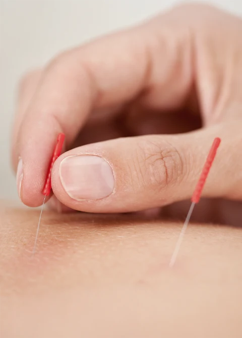 Close-up of a practitioner inserting fine acupuncture needles into the skin with precision.